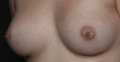 Nipple Revision Before & After Patient #36464