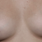 Nipple Revision Before & After Patient #36464
