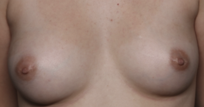 Nipple Revision Before & After Patient #36464