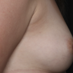 Nipple Revision Before & After Patient #36464