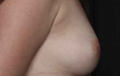 Nipple Revision Before & After Patient #36464
