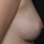 Nipple Revision Before & After Patient #36464