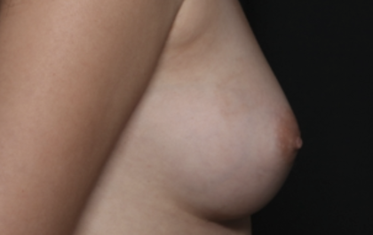 Nipple Revision Before & After Patient #36464
