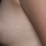 Nipple Revision Before & After Patient #36464