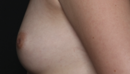 Nipple Revision Before & After Patient #36464