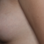 Nipple Revision Before & After Patient #36464