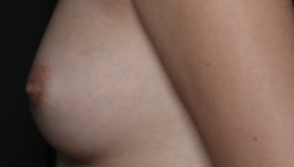 Nipple Revision Before & After Patient #36464