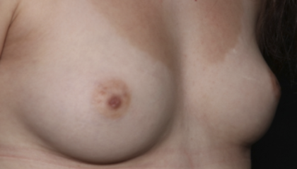 Nipple Revision Before & After Patient #36464