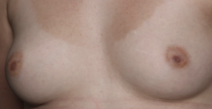 Nipple Revision Before & After Patient #36464