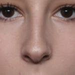 Rhinoplasty Before & After Patient #36486