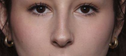 Rhinoplasty Before & After Patient #36486