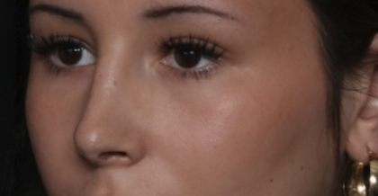 Rhinoplasty Before & After Patient #36486