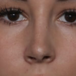 Rhinoplasty Before & After Patient #36486