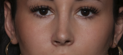 Rhinoplasty Before & After Patient #36486