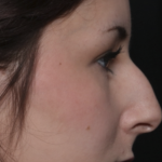Rhinoplasty Before & After Patient #36486