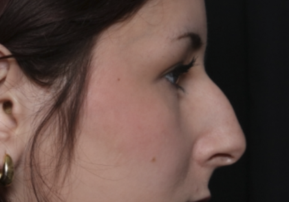 Rhinoplasty Before & After Patient #36486