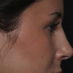 Rhinoplasty Before & After Patient #36486