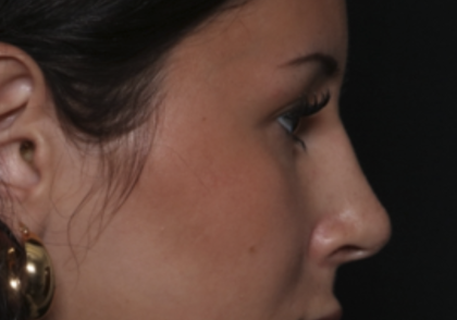 Rhinoplasty Before & After Patient #36486