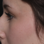Rhinoplasty Before & After Patient #36486
