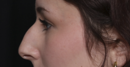 Rhinoplasty Before & After Patient #36486