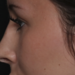 Rhinoplasty Before & After Patient #36486