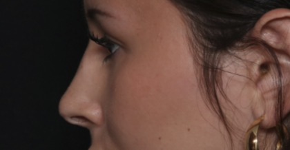 Rhinoplasty Before & After Patient #36486