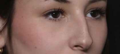 Rhinoplasty Before & After Patient #36486
