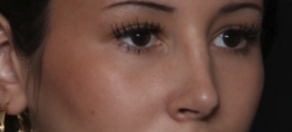 Rhinoplasty Before & After Patient #36486