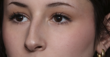 Rhinoplasty Before & After Patient #36486