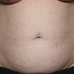 Tummy Tuck Before & After Patient #36585