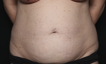 Tummy Tuck Before & After Patient #36585