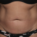 Liposuction Before & After Patient #36488