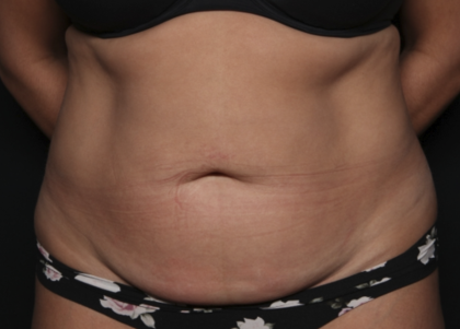 Liposuction Before & After Patient #36488