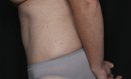 Tummy Tuck Before & After Patient #36585