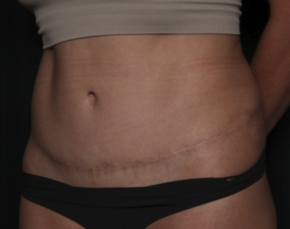 Liposuction Before & After Patient #36488