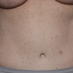 Tummy Tuck Before & After Patient #36585