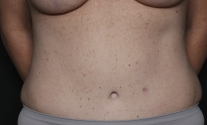 Tummy Tuck Before & After Patient #36585