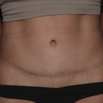 Liposuction Before & After Patient #36488