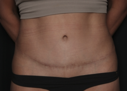 Liposuction Before & After Patient #36488