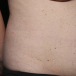 Tummy Tuck Before & After Patient #36585