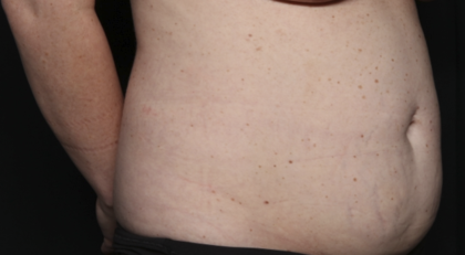 Tummy Tuck Before & After Patient #36585