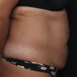 Liposuction Before & After Patient #36488