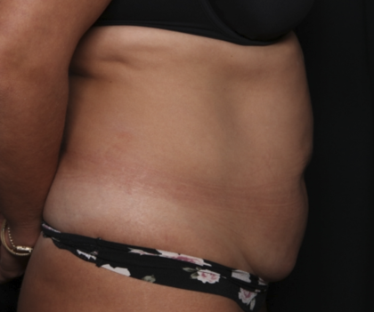 Liposuction Before & After Patient #36488