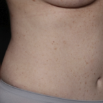Tummy Tuck Before & After Patient #36585