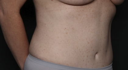 Tummy Tuck Before & After Patient #36585