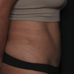 Liposuction Before & After Patient #36488