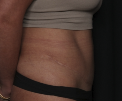 Liposuction Before & After Patient #36488