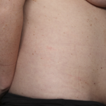 Tummy Tuck Before & After Patient #36585