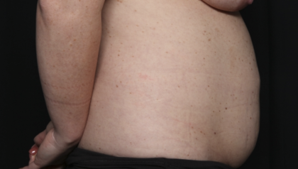 Tummy Tuck Before & After Patient #36585