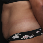 Liposuction Before & After Patient #36488